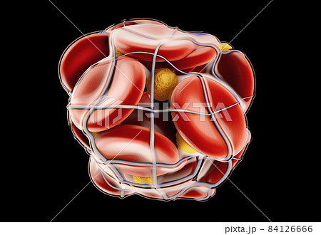 3d Illustration of Deep Vein Thrombosis or Blood Clots. Embolism, clipping path included 84126666