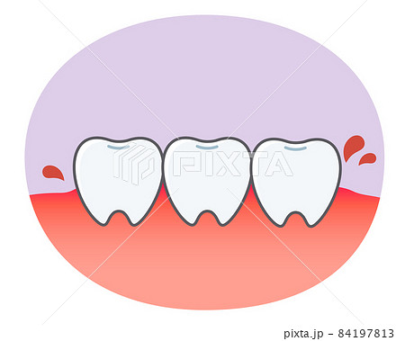 歯肉炎の歯や歯茎の可愛いイラストのイラスト素材