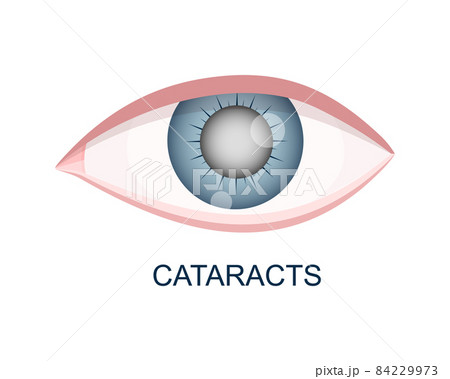 Cataract eye close up view. Eyeball with cloudy lens. Anatomically accurate human organ of vision with aging problems Cataract eye close up view. Eyeball with cloudy lens. Anatomically accurate human organ of vision with aging problems 84229973