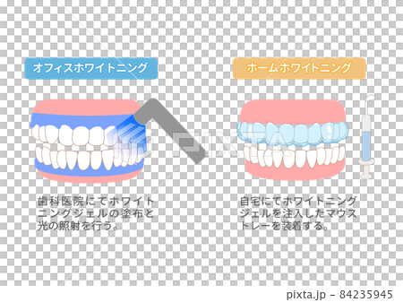 Illustration of the difference between home whitening and office whitening 84235945