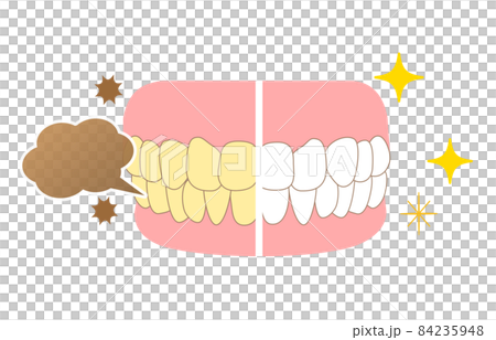 牙齒著色和美白 84235948