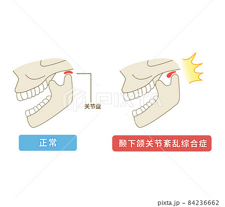 中国語　顎関節症の仕組みのイラスト 84236662