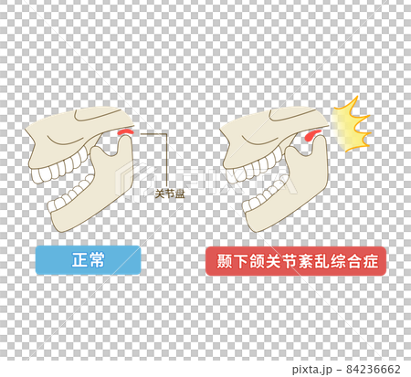 中国語　顎関節症の仕組みのイラスト 84236662