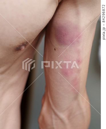 打撲で損傷した腕 84296872