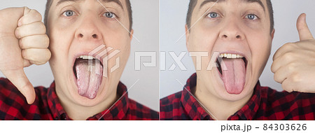 Before and after. White curd on the tongue. A physician or gastroenterologist examines a man tongue. Patient has poor oral hygiene or a symptom of illness. Symptoms of a latent disease. Before and after. White curd on the tongue. A physician or gastroenterologist examines a man tongue. Patient has poor oral hygiene or a symptom of illness. Symptoms of a latent disease. 84303626