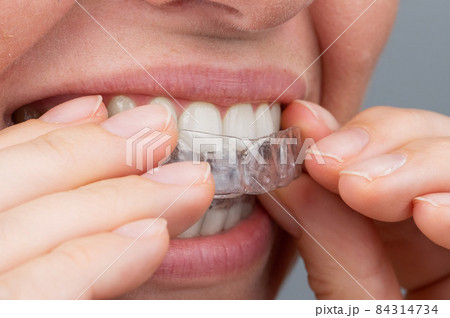 Caucasian woman putting on aligners. Orthodontic teeth straightening device. Caucasian woman putting on aligners. Orthodontic teeth straightening device. 84314734