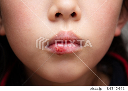 唇が荒れた子供 84342441