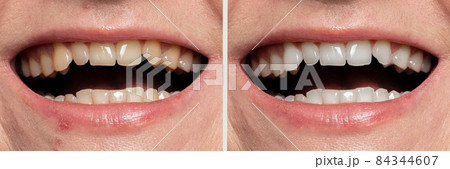 teeth whitening before and after teeth whitening before and after 84344607