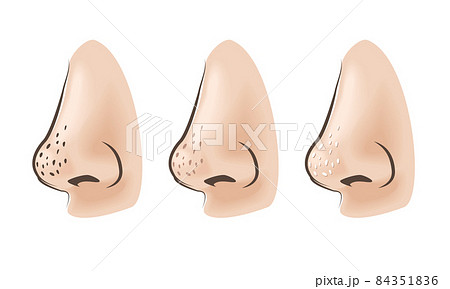 鼻の毛穴トラブル 鼻の毛穴トラブル 84351836