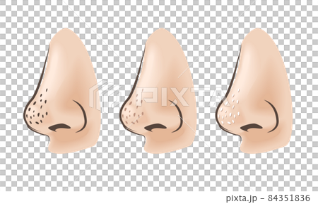 鼻の毛穴トラブル 鼻の毛穴トラブル 84351836