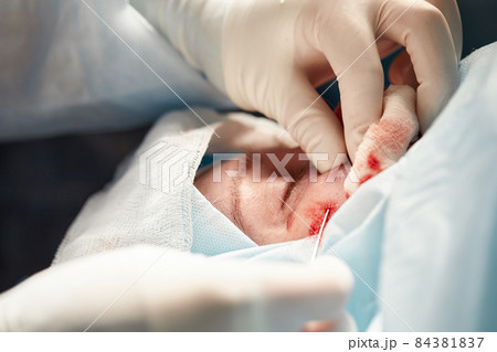 Close up of the face of a patient who is undergoing blepharoplasty. The surgeon cuts the eyelid and performs manipulations using medical instruments 84381837