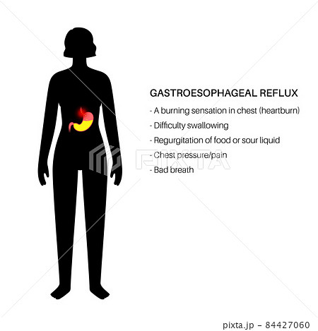 Gastroesophageal reflux disease Gastroesophageal reflux disease 84427060