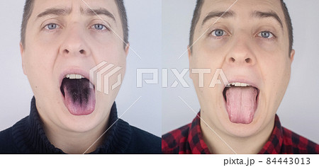 Before and after. Close-up of a man black tongue. Clinical manifestations of lingua villosa. Bacterial infection of the mouth. The consequences of taking strong antibiotics. Fungal infection 84443013