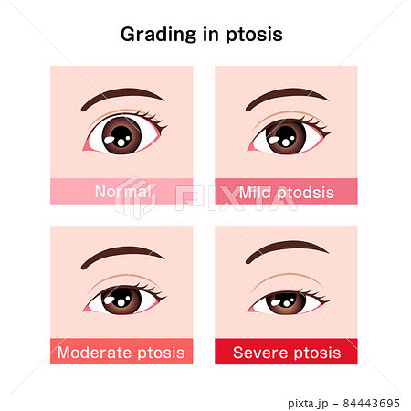 眼瞼下垂症の重症度比較 ベクターイラスト (英語)のイラスト素材