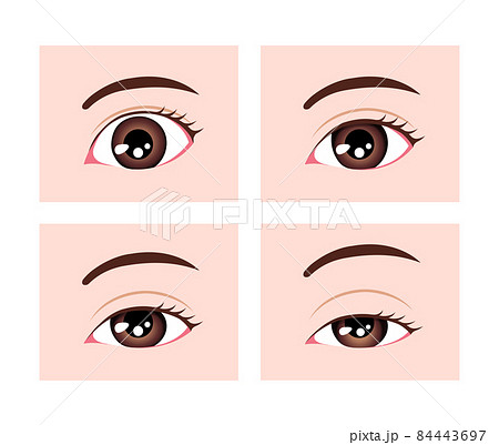 眼瞼下垂症の重症度比較 ベクターイラスト (文字なし) 84443697
