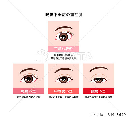 眼瞼下垂症の重症度比較 ベクターイラスト 84443699