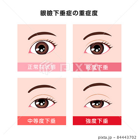 眼瞼下垂症の重症度比較 ベクターイラスト 84443702