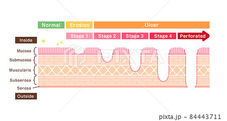 胃壁の断面図イラスト / 胃潰瘍の症状と重症度 (英語) 胃壁の断面図イラスト / 胃潰瘍の症状と重症度 (英語) 84443711