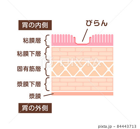 胃壁の断面図イラスト / 胃潰瘍の初期症状 (びらん) 胃壁の断面図イラスト / 胃潰瘍の初期症状 (びらん) 84443713