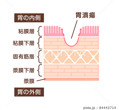 胃壁の断面図イラスト / 胃潰瘍の発生 胃壁の断面図イラスト / 胃潰瘍の発生 84443714