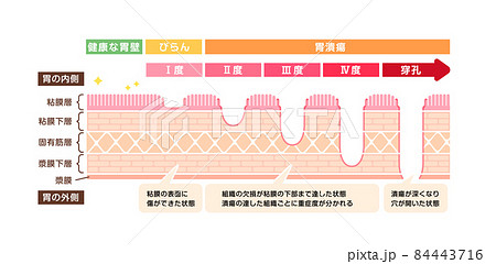 胃壁の断面図イラスト / 胃潰瘍の症状と重症度 (解説文付) 84443716
