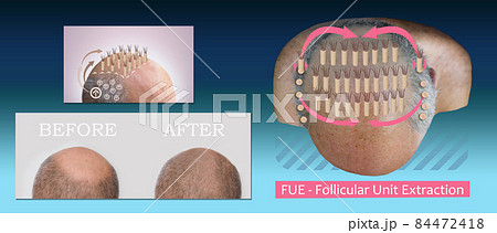 Methods of hair transplantation fut vs fue with infographic elements of illustration. 84472418