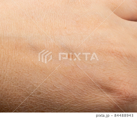 Skin mole closeup. Macro photo of blemish similar to melanoma 84488943