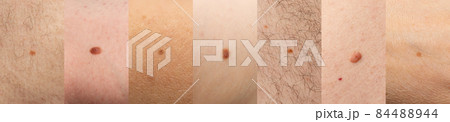 Skin mole closeup. Macro photo of blemish similar to melanoma 84488944