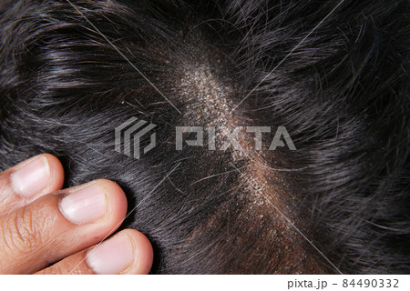 men with dandruff in his hair, closeup men with dandruff in his hair, closeup 84490332