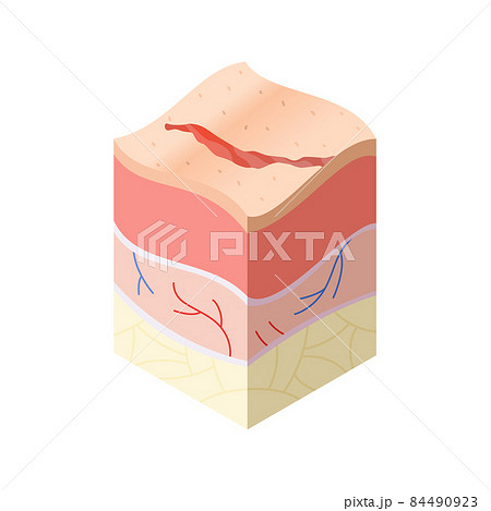 Skincare medical concept. Problems in cross-section of human skin horizontal layers structure. Anatomy illustrative model Skincare medical concept. Problems in cross-section of human skin horizontal layers structure. Anatomy illustrative model 84490923