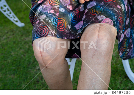 Asian senior lady old woman patient show her scars surgical total knee joint replacement. Asian senior lady old woman patient show her scars surgical total knee joint replacement. 84497286