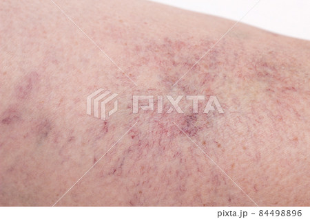 Footprint on the skin from vascular dilatation of veins, vascular pattern on human skin, close-up, phlebeurysm, capillaries 84498896