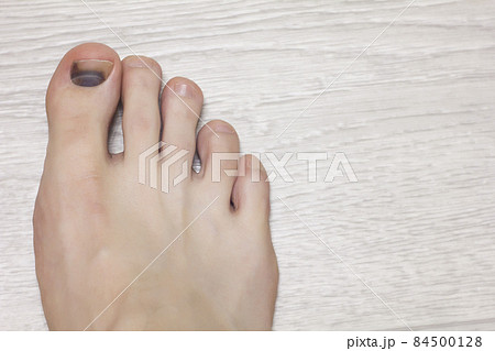 Injury to the nail on the foot, close-up, hematoma under the nail, copy space, trauma, medic Injury to the nail on the foot, close-up, hematoma under the nail, copy space, trauma, medic 84500128