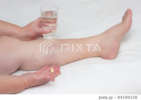 A woman is holding a pill for treating varicose veins on her legs and a glass of water, drugs for the treatment of thrombophlebitis, close-up 84500156