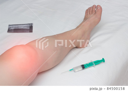 The inflamed leg of a woman with an affected knee joint from arthrosis and arthritis lies next to a syringe with Gilauri acid and a Honndroprotector The inflamed leg of a woman with an affected knee joint from arthrosis and arthritis lies next to a syringe with Gilauri acid and a Honndroprotector 84500158