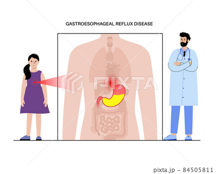 Gastroesophageal reflux disease Gastroesophageal reflux disease 84505811