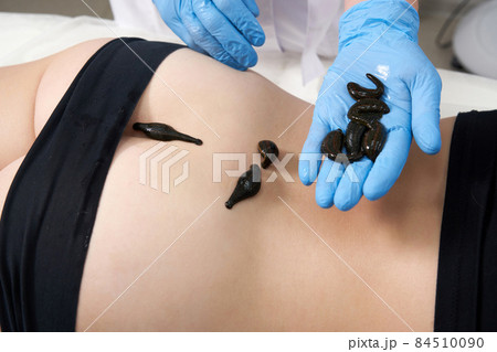 doctor puts the leech, close-up, applying leech it to the patient's skin doctor puts the leech, close-up, applying leech it to the patient's skin 84510090