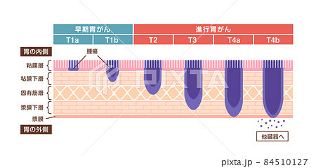 胃壁の断面図イラスト / 胃がん・胃癌の症状と重症度ステージ  84510127