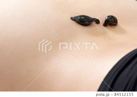 medical leeches on a human body drink blood. Treatment with leeches medical leeches on a human body drink blood. Treatment with leeches 84512155