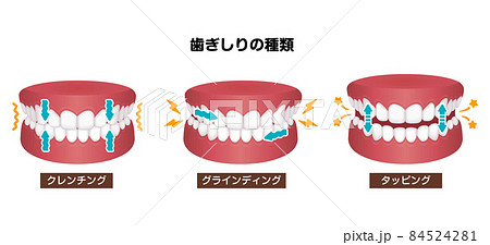 歯軋り（歯ぎしり）の種類 ベクターイラスト 84524281