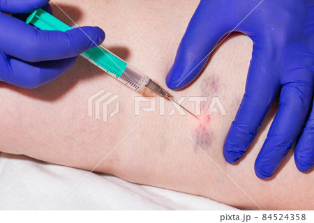 Doctor makes sclerotherapy injection into patient's damaged veins, thrombosis and bruises. Varicose Veins Treatment, close-up 84524358