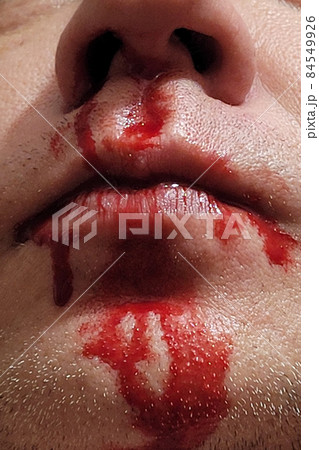 Blood on the nose and lips of a person. The consequences of the fight. Close-up 84549926