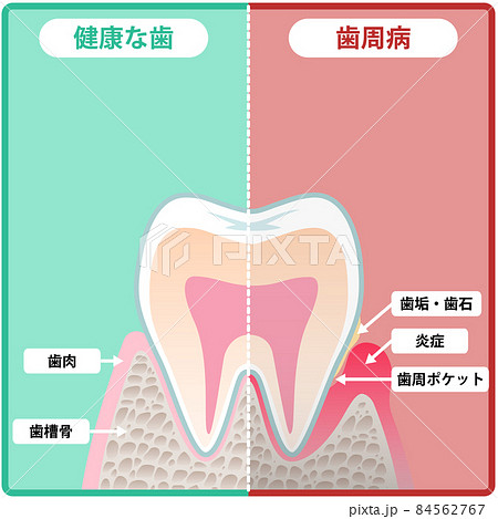 歯の断面 84562767