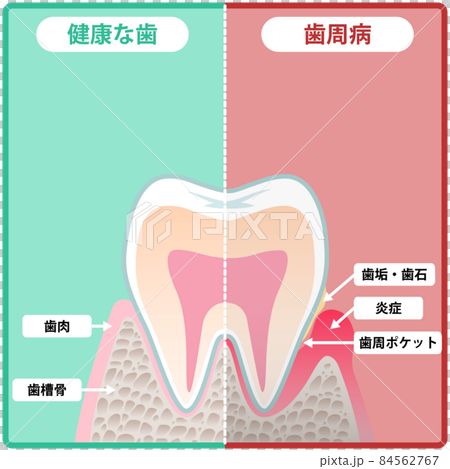 歯の断面 84562767