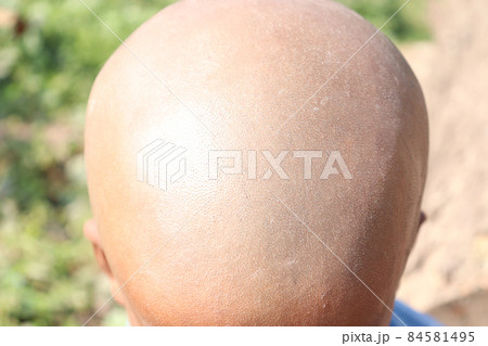a bald closeup of child after hire cut 84581495