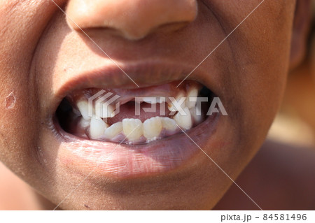 tooth closeup of a child with lips 84581496