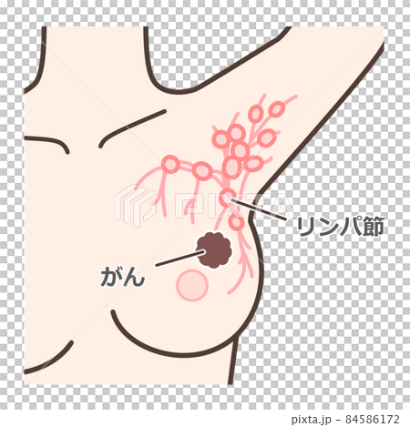 前哨淋巴結活檢評論插圖 84586172