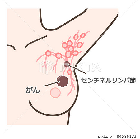 センチネルリンパ節生検の解説イラスト センチネルリンパ節生検の解説イラスト 84586173