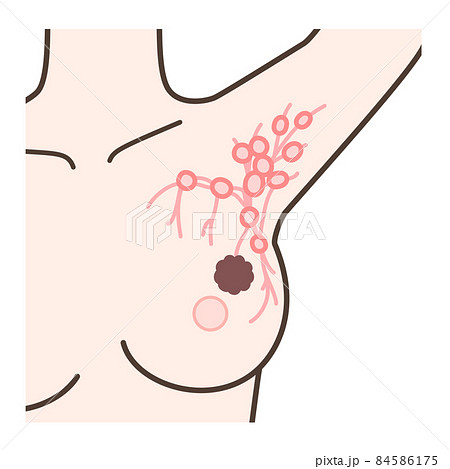 センチネルリンパ節生検の解説イラスト 84586175