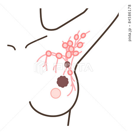 センチネルリンパ節生検の解説イラスト 84586178